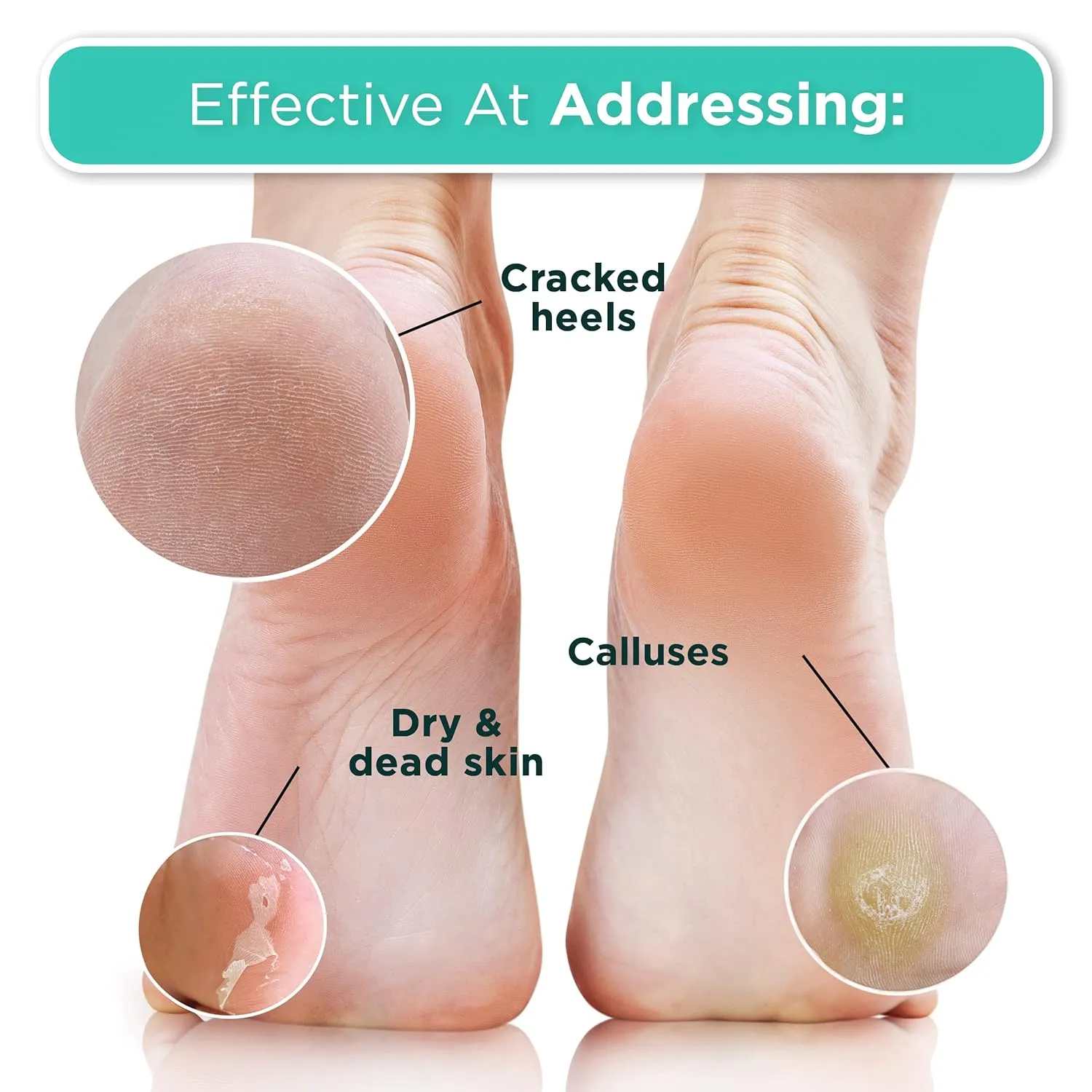DERMORA Foot Peel Mask - 2 Pack of Regular Size Skin Exfoliating Foot Masks for Dry, Cracked Feet, Callus, Dead Skin Remover for Baby Soft Feet, Tea Tree Scent